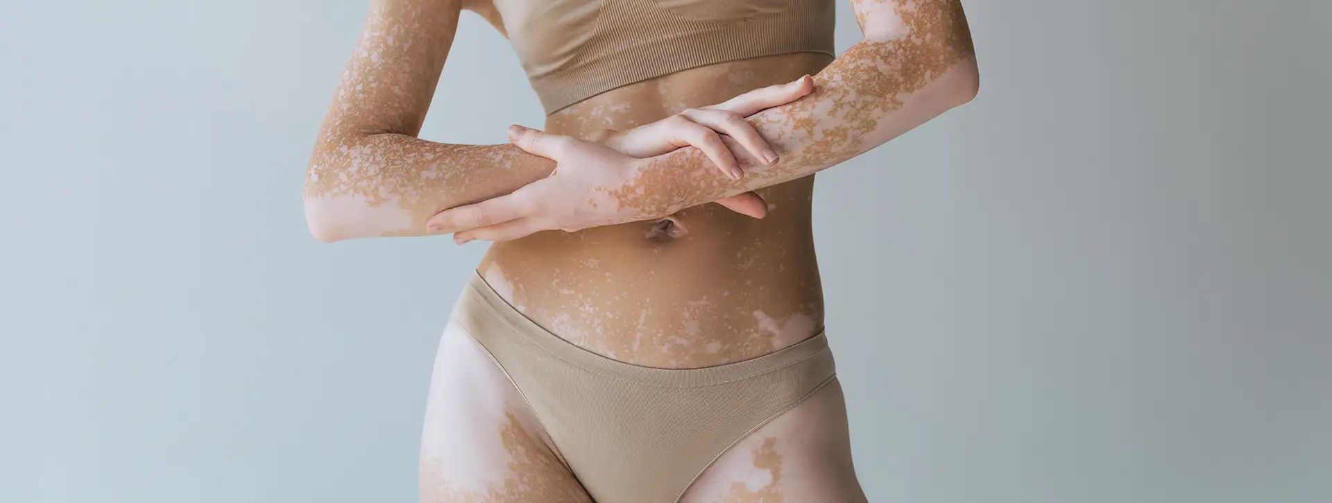 Vitiligo — Dermatologia Clínica VOSS Dermatologia