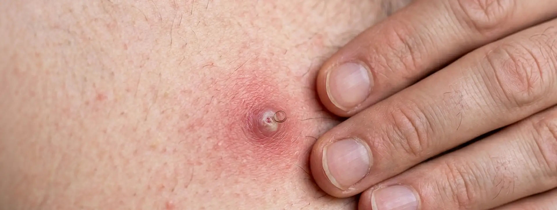 Foliculite — Dermatologia Clínica VOSS Dermatologia