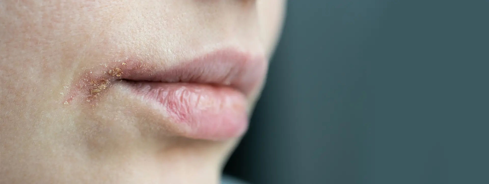Herpes — Dermatologia Clínica VOSS Dermatologia