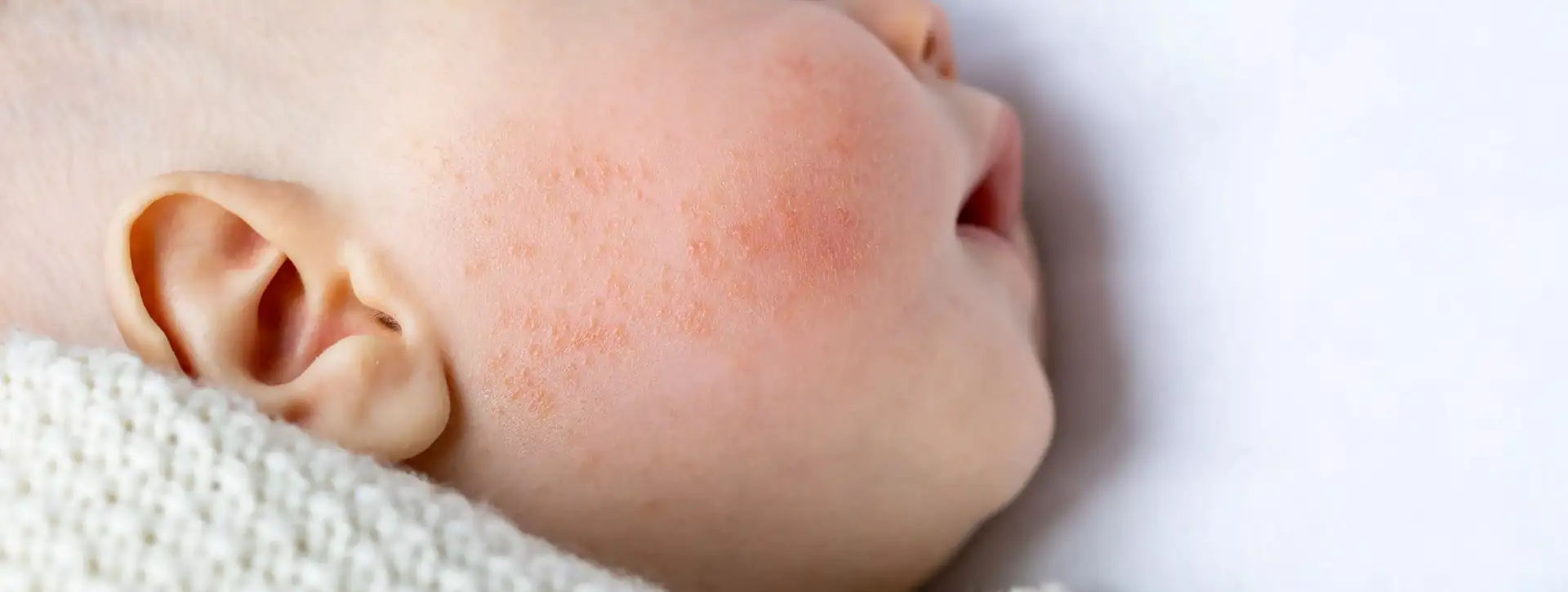 Miliária (Brotoeja) — Dermatologia Clínica VOSS Dermatologia