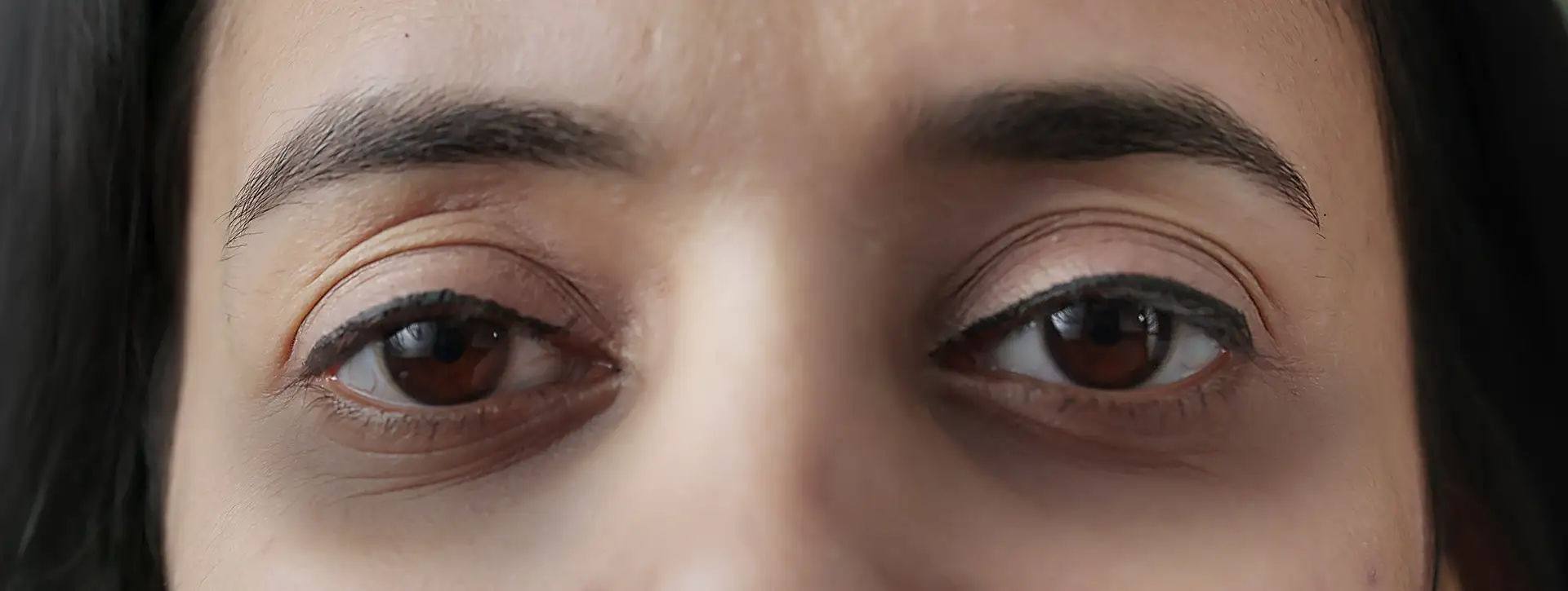 Olheiras — Dermatologia Estética VOSS Dermatologia