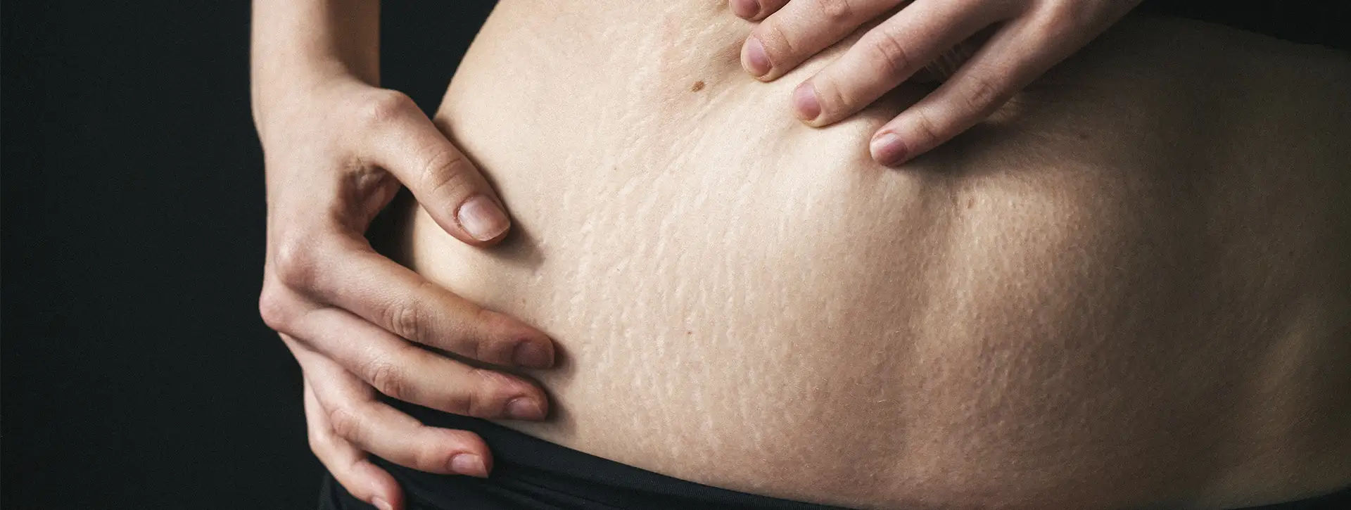Estrias — Dermatologia Estética VOSS Dermatologia