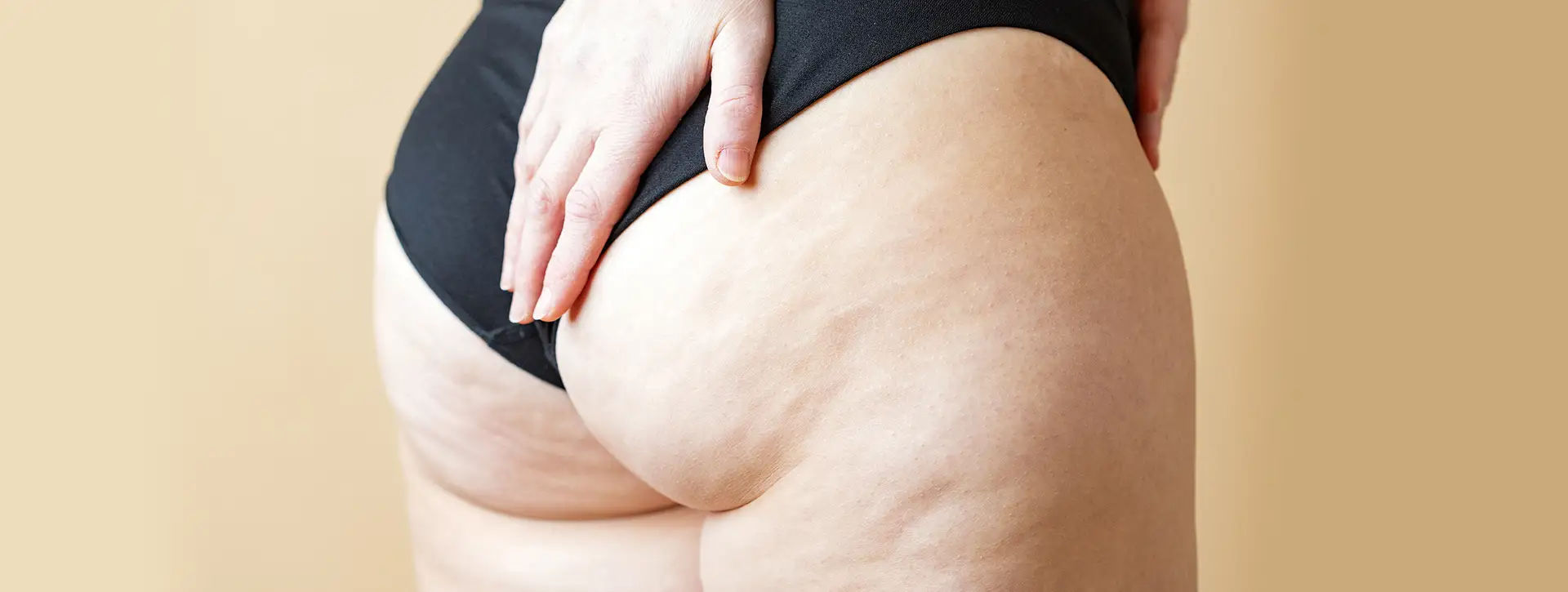 Celulite — Dermatologia Estética VOSS Dermatologia