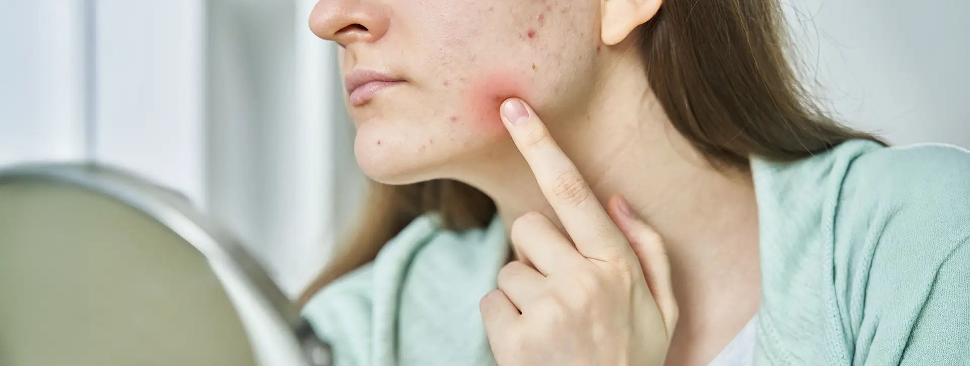 Acne — Dermatologia Clínica VOSS Dermatologia