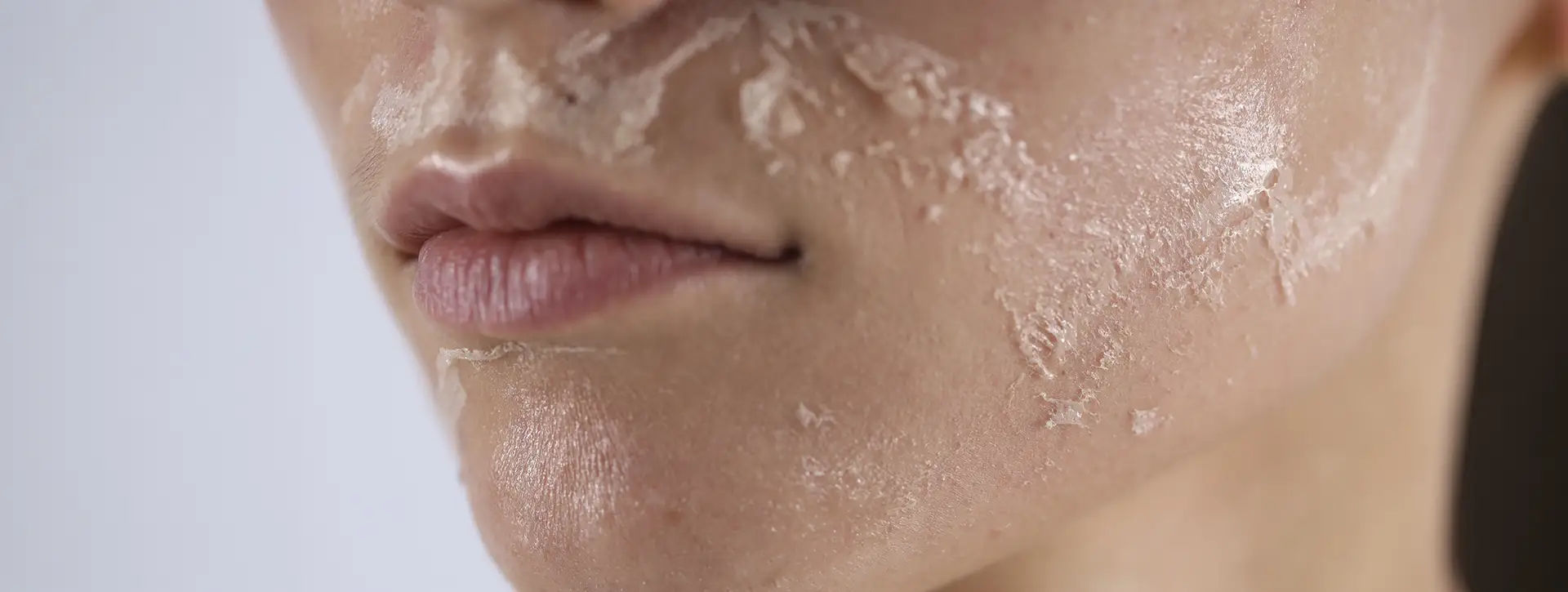 Peeling — Dermatologia Estética VOSS Dermatologia