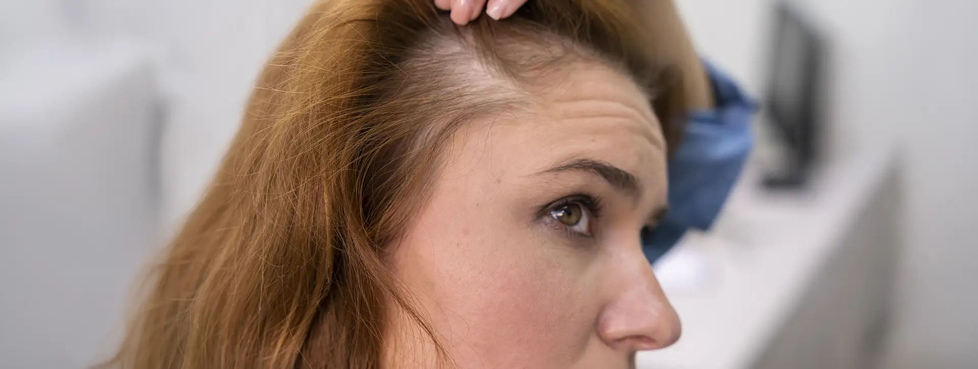 Alopecia Fibrosante Frontal — Dermatologia Capilar VOSS Dermatologia