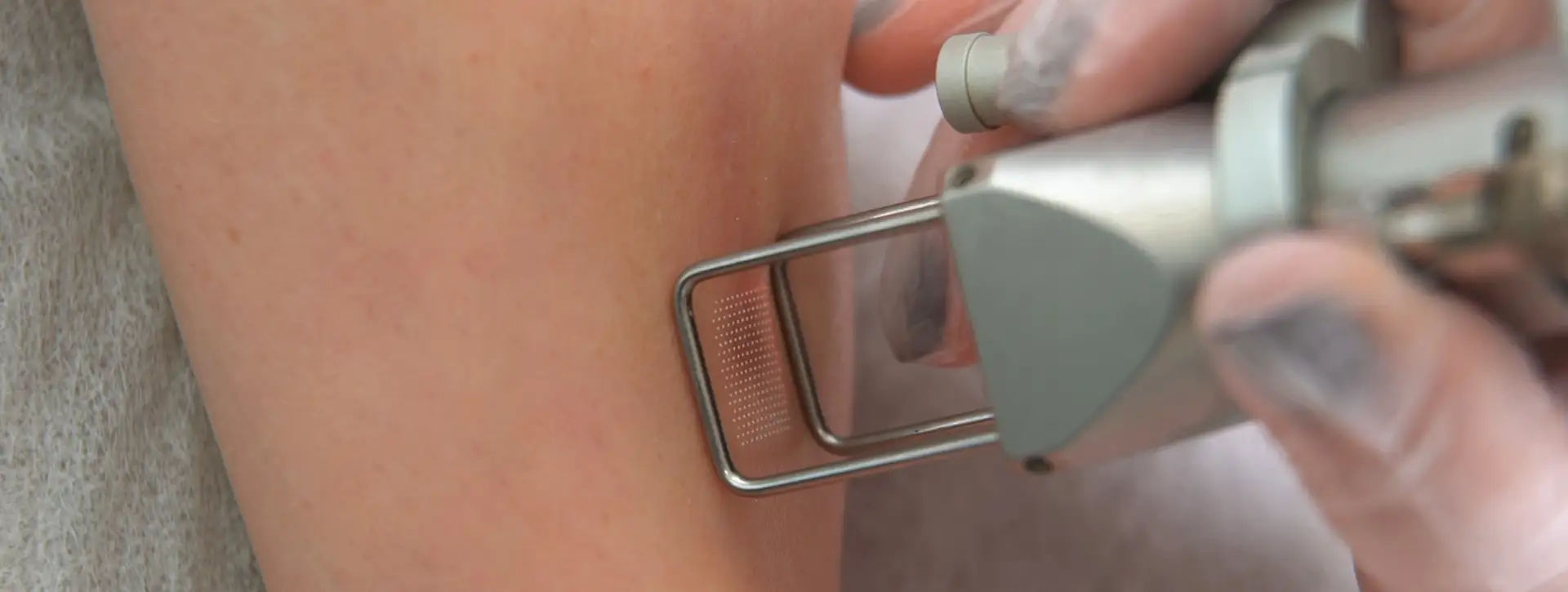 Laser CO2 Fracionado — Tecnologias e Inovações VOSS Dermatologia
