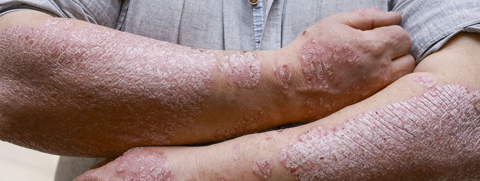 Psoríase — Dermatologia Clínica VOSS Dermatologia
