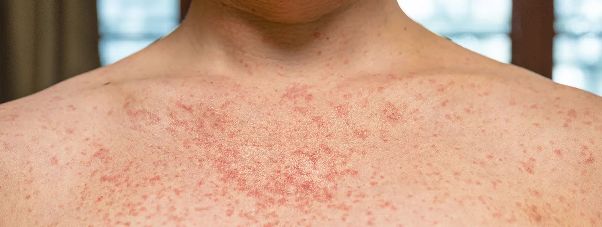 Dermatite Atópica — Dermatologia Clínica VOSS Dermatologia
