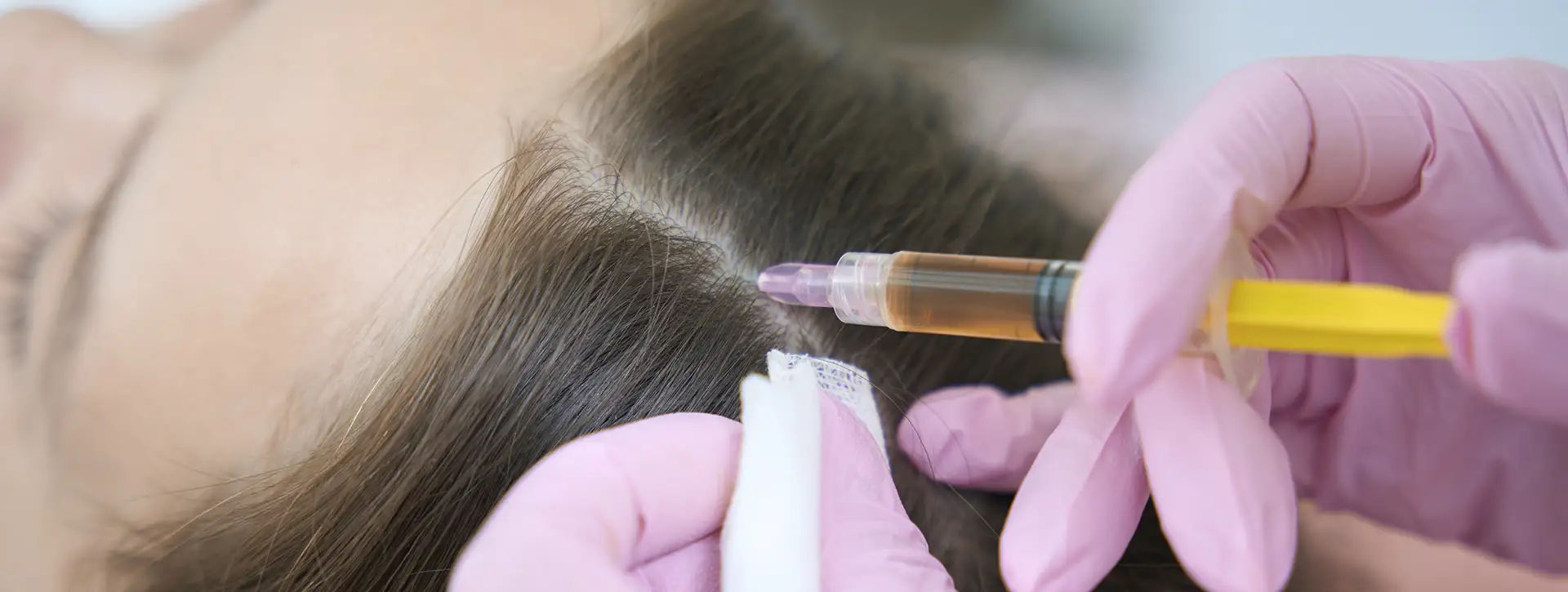 Plasma Rico em Plaquetas (PRP) — Tratamento Capilar — Tecnologias e Inovações VOSS Dermatologia